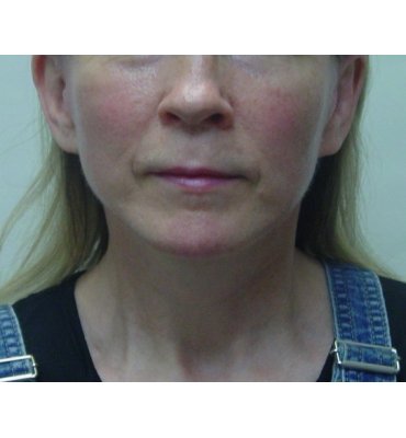 facelift with malar fat graft